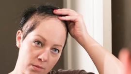 Trikotillomani (Saç Yolma-Çekme Hastalığı) Nedir?