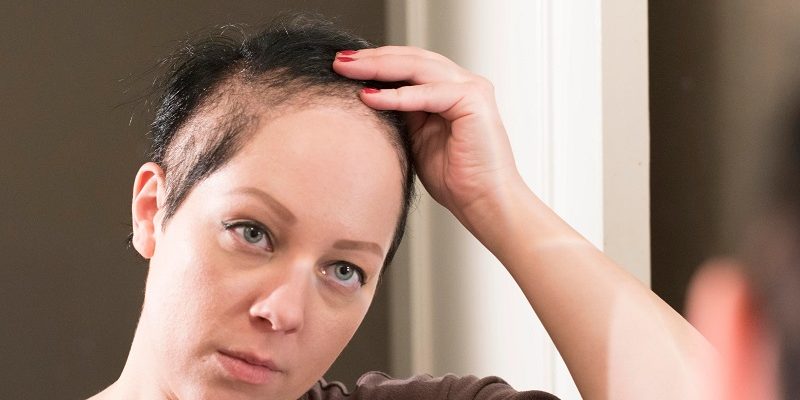 Konya Vajinismus 4 Trikotillomani (Saç Yolma-Çekme Hastalığı) Nedir?